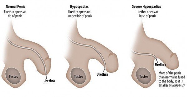pénisz hypospadias